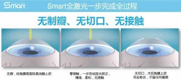 安庆二院：激光眼科手术矫正迈入飞秒全激光时代