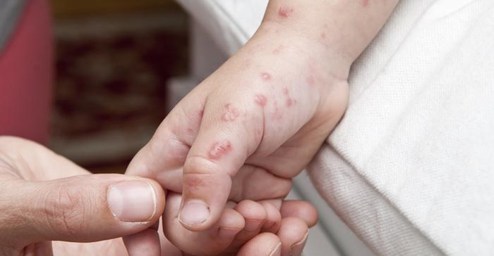 男孩染水痘出红疹被当成荨麻疹治疗，险并发脑膜炎！
