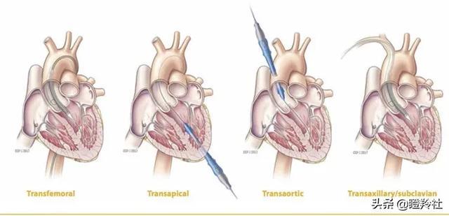 心脏瓣膜赛道深度投研笔记：微创心通将在年底前反超启明医疗？