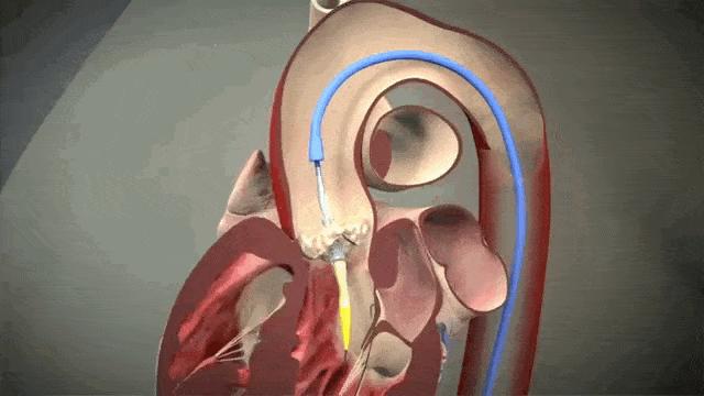 心脏瓣膜赛道深度投研笔记：微创心通将在年底前反超启明医疗？