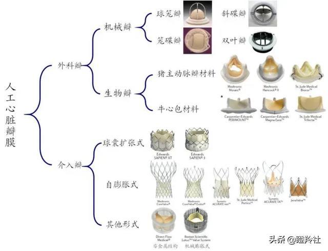 心脏瓣膜赛道深度投研笔记：微创心通将在年底前反超启明医疗？