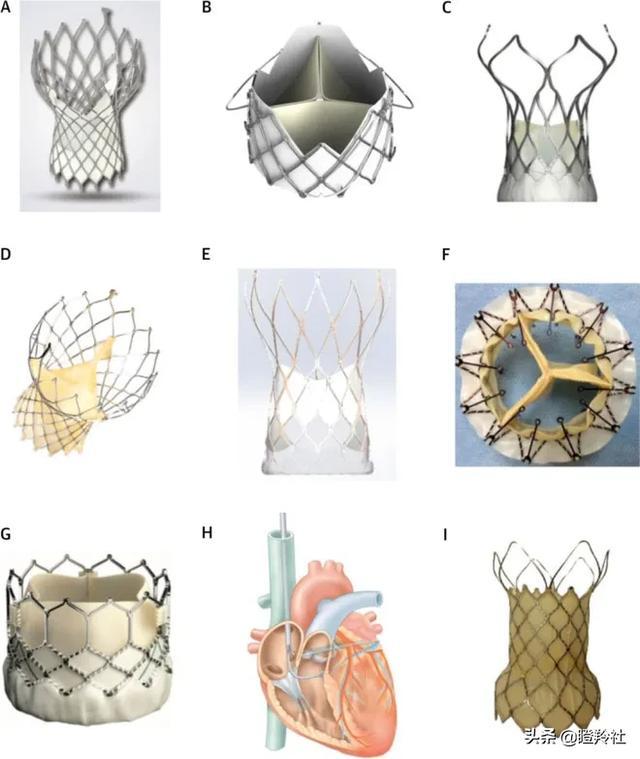 心脏瓣膜赛道深度投研笔记：微创心通将在年底前反超启明医疗？