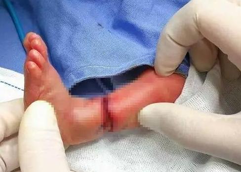 胎儿患罕见病，出生后伤口似被“绑腿”，深可见骨！医生：要截肢