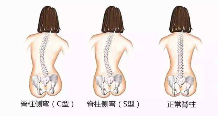 小儿推拿杨晓：儿童脊柱侧弯的危害？如何预防青少年脊柱侧弯?