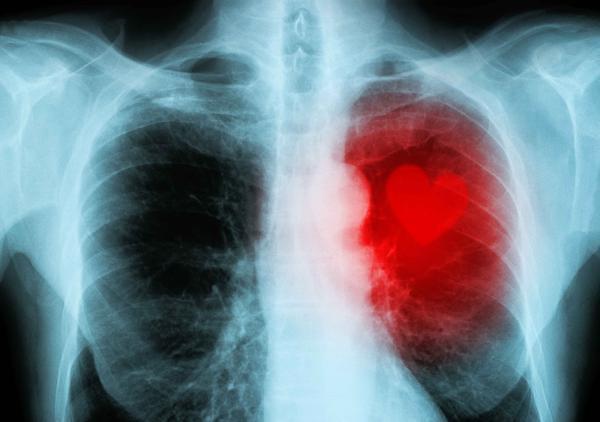 若有这三种表现，别再以为是支气管炎了，警惕是肺癌的早期征兆
