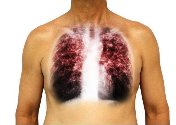 若有这三种表现，别再以为是支气管炎了，警惕是肺癌的早期征兆