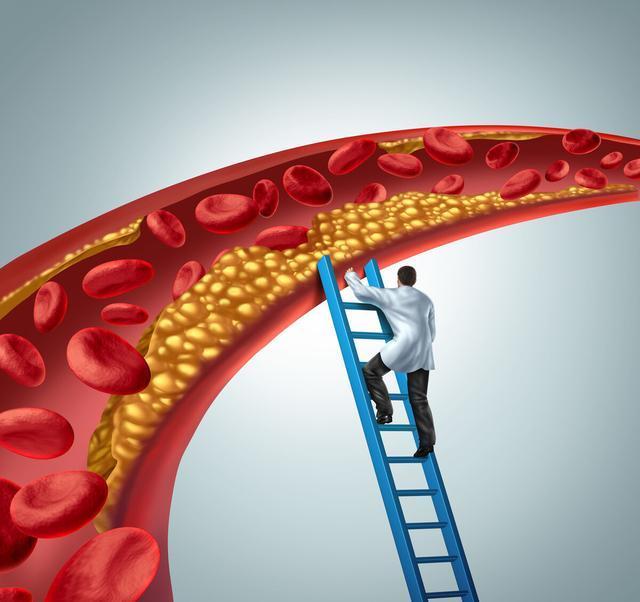 动脉硬化斑块不想发展成大问题，这3个阶段，积极行动起来都不晚