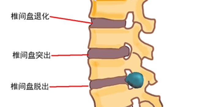 中医治疗腰椎病的原理是什么_幸福是什么图片