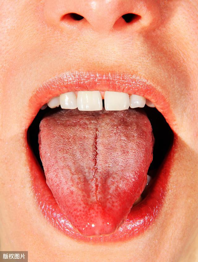 你舌头上有裂纹吗？注意了