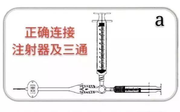 PICC堵管不要慌，尿激酶来帮忙！