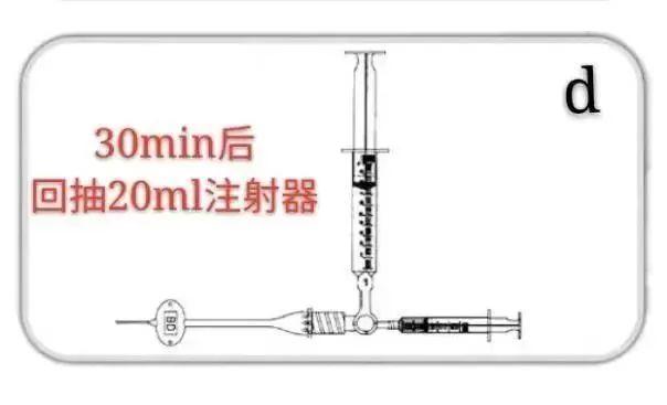 PICC堵管不要慌，尿激酶来帮忙！