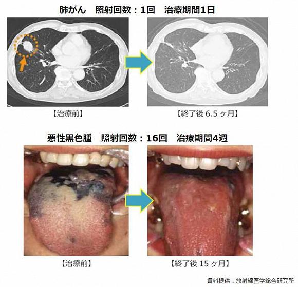 日本最新抗癌疗法BNCT疗法后效果显著,图一肺癌,图二黑色素瘤