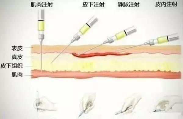 经验干货分享：注射技巧总结大全！仅此一份！