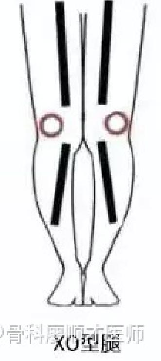 腿部图片来源:知乎@骨科廖顺才医师