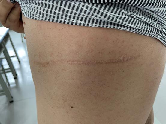 图:努尔麦麦提中弹后留下的伤痕