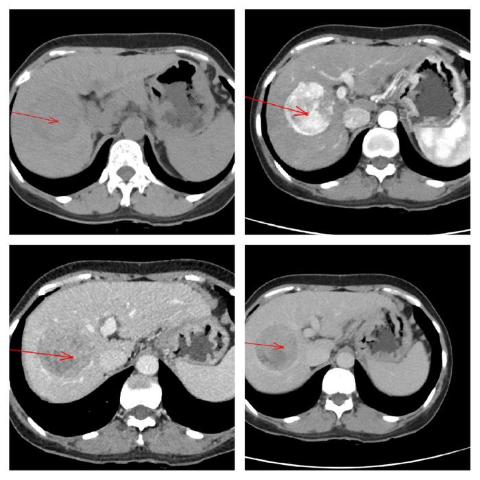 肝癌，胰腺癌，转移瘤……一文理清肝胆胰常见疾病的CT 鉴别诊断
