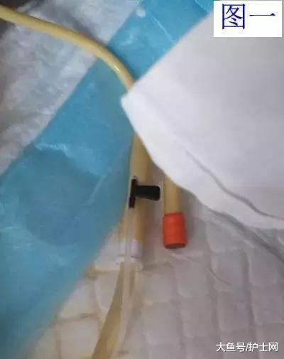 三腔导尿管怎么使用膀胱冲洗, 差点导致针刺伤!_新闻资讯_第1张_活检穿刺产品网 三腔导尿管怎么使用膀胱冲洗, 差点导致针刺伤!_https://www.jmylbn.com_新闻资讯_第1张
