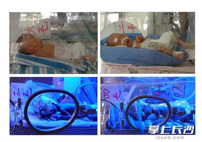△四胞胎18年前在湖南省儿童医院救治。