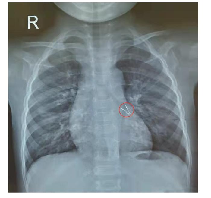 1岁半宝宝咳嗽一周肺里有“长脚”异物，竟是过节用的小灯泡