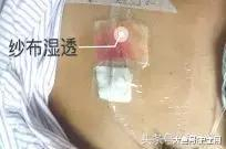 为什么输液要盖块纱布输液港敷贴更换6问6答!_https://www.jmylbn.com_新闻资讯_第6张