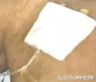 为什么输液要盖块纱布输液港敷贴更换6问6答!_新闻资讯_第4张_活检穿刺产品网 为什么输液要盖块纱布输液港敷贴更换6问6答!_https://www.jmylbn.com_新闻资讯_第4张