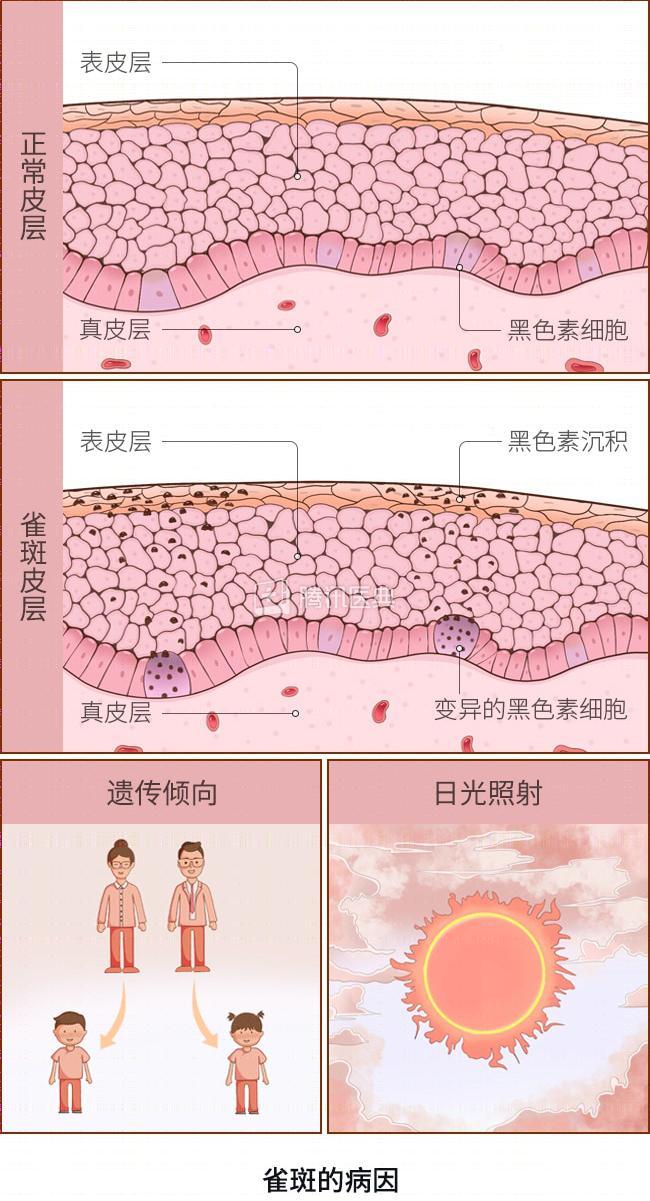 黄褐斑、雀斑、老年斑……各种斑该怎么除？一文带你了解