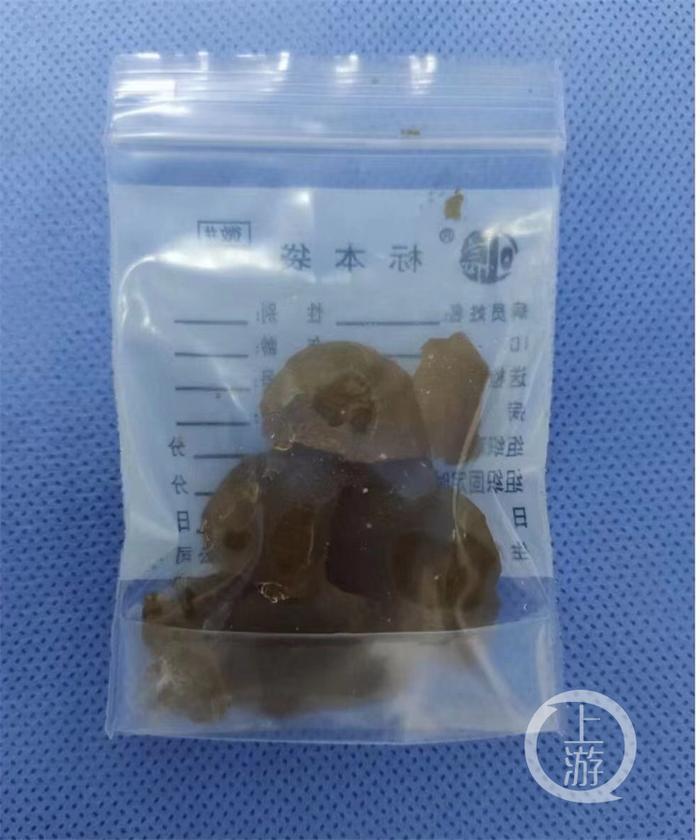 1岁幼儿误食水宝宝肚子胀得像气球 医生：这些玩具容易误食