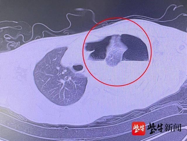 搬重物后胸痛气急 24岁小伙突发血气胸(图2)