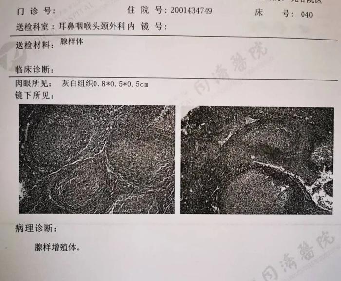 保守治疗1年多吃尽苦头，孩子的腺样体手术我真后悔切晚了