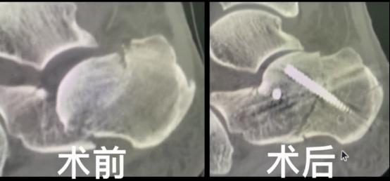 切口仅1厘米，螺钉固定精准到亚毫米级！关节镜机器人齐齐助力骨折手术