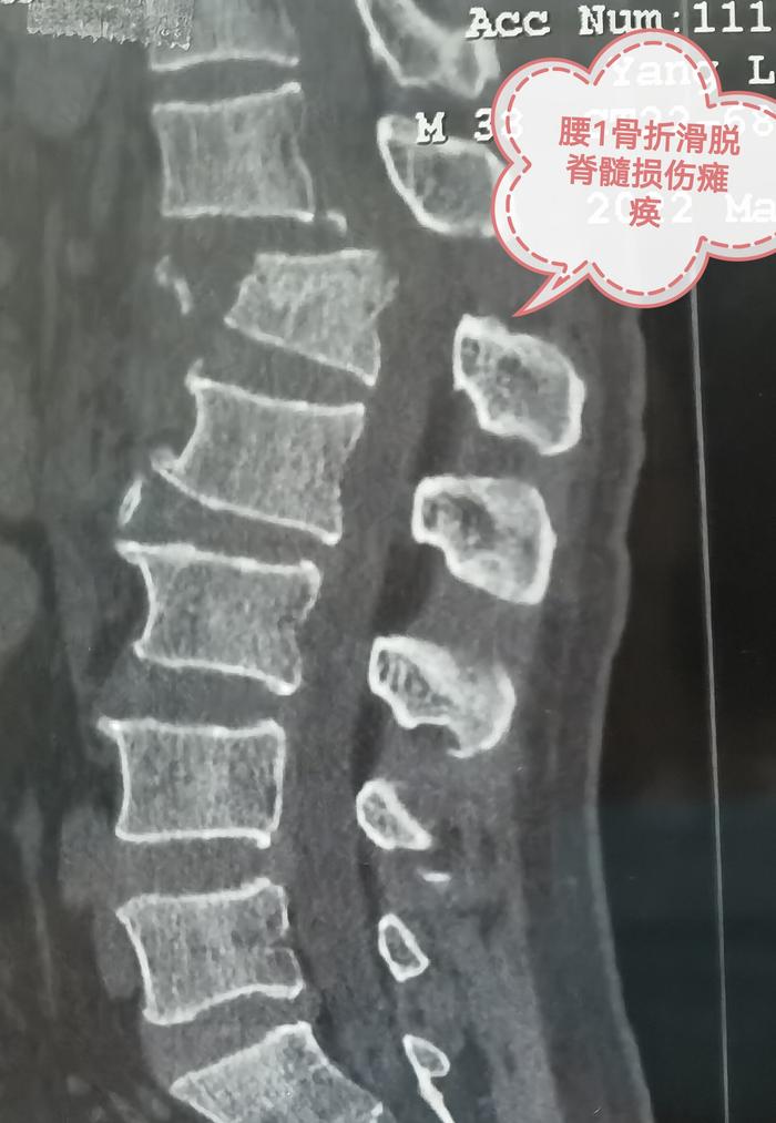 小便失禁，紧急送往当地医院检查发现胸腰段骨折，脊柱滑脱，脊髓损伤。术前ct及mri均提示胸12/腰1