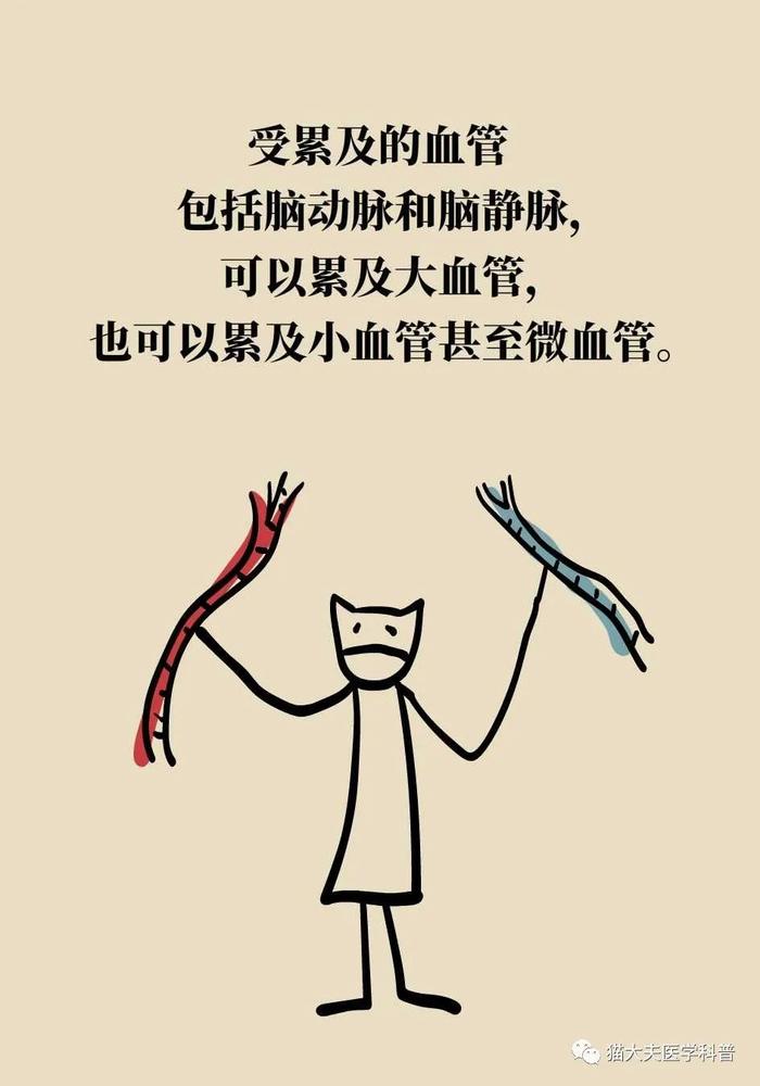 脑梗死、脑出血、脑卒中、脑中风，是不是一回事？