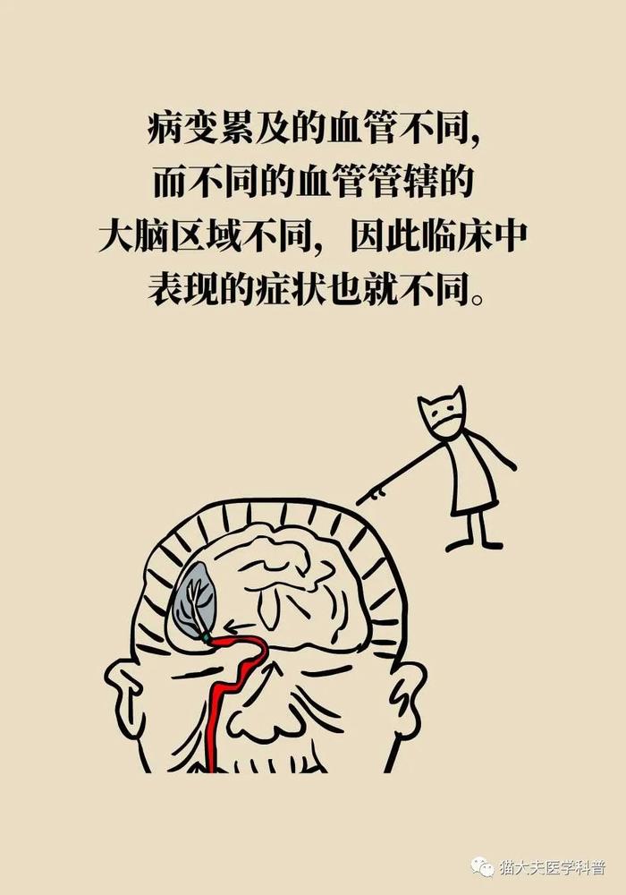 脑梗死、脑出血、脑卒中、脑中风，是不是一回事？