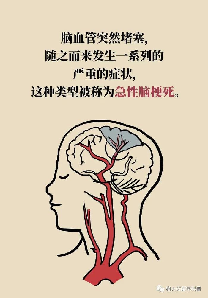 脑梗死、脑出血、脑卒中、脑中风，是不是一回事？