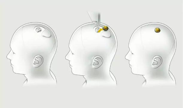 电厂丨美国实施了第一例人体脑机接口手术，渐冻症患者有了新的希望