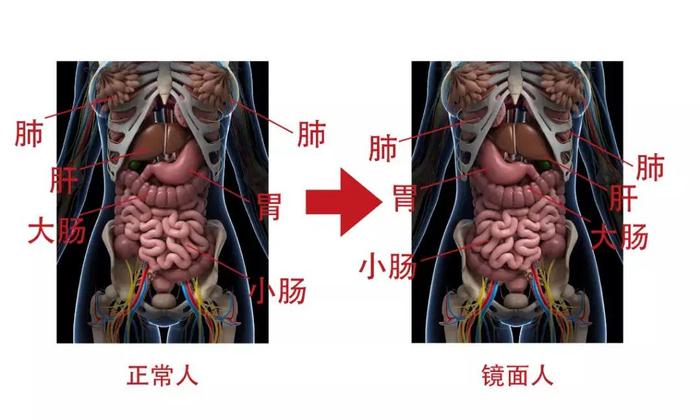 罕见！女子五脏六腑全部反着长，体内还有一块巨大的…