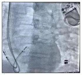 北京积水潭医院心内科成功为外籍友人植入世界上最小的无导线起搏器