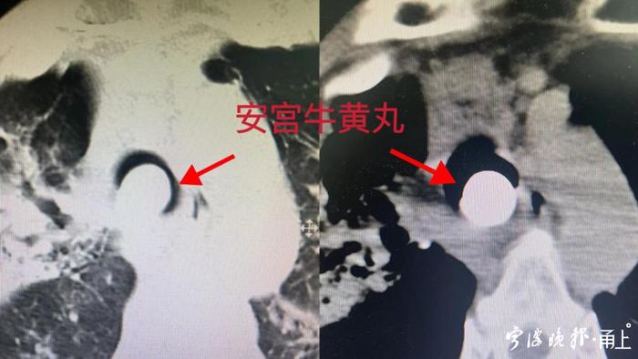 警惕！浙江一老人错服“神药”，氧饱和度掉到80%