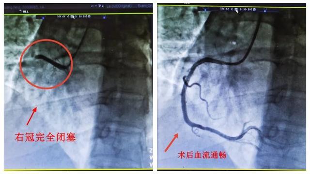 阳性一个月后，风险增加33倍！竟都和出汗脱水有关……