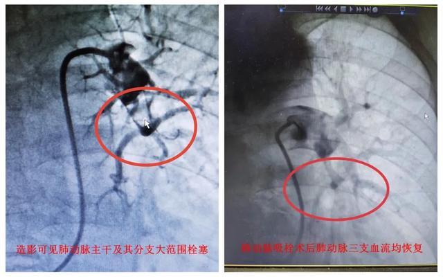 阳性一个月后，风险增加33倍！竟都和出汗脱水有关……