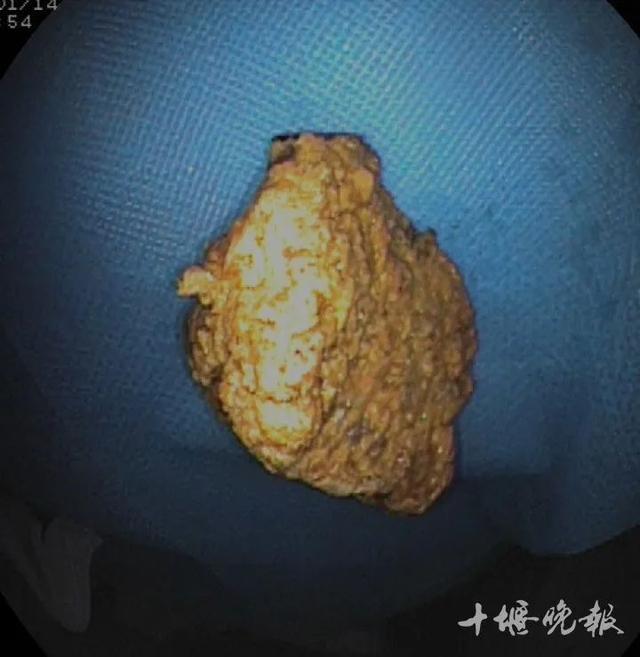 老人胃里长出拳头大结石，竟是因为多吃了这种水果……