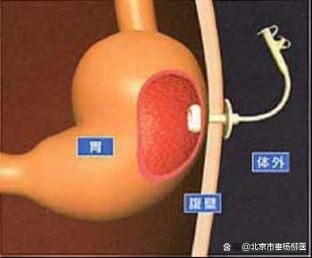 垂医科普 | 不能进食怎么办？胃造瘘来解决