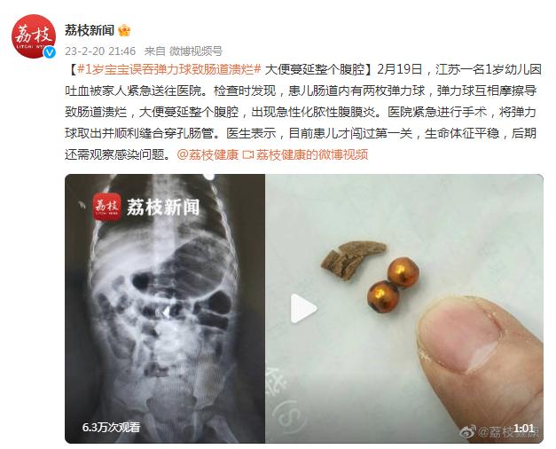 1岁宝宝误吞弹力球致肠道溃烂，大便蔓延整个腹腔……