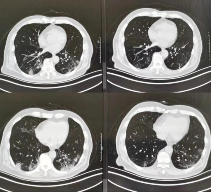 上海有人"阳康"后拍CT,发现肺里有"伤疤"?要紧吗?最新解答