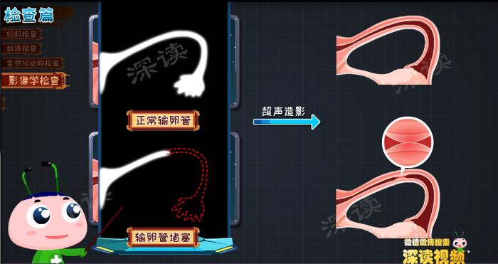 输卵管炎该如何确诊？最正确的治疗方法有哪些？良心知识科普贴！(图4)