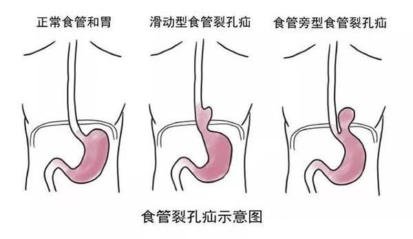 胸腔长巨大“恶性肿瘤”却无不适症状？会诊发现竟是疝入脂肪组织