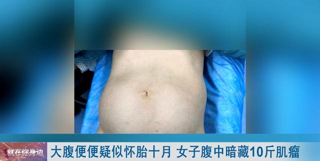 警惕！49岁女子大肚如10月怀胎， 医院一查竟是…