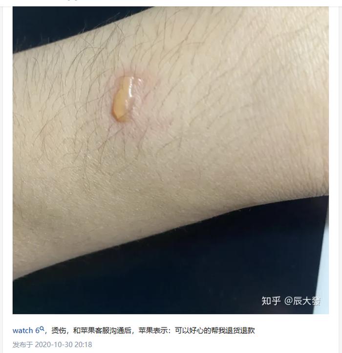 苹果手表致使多名用户手腕红肿，甚至曾发热爆炸，涉及多个型号