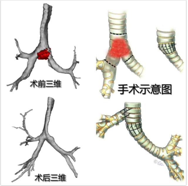 吉林省首例！这次手术历经3小时25分