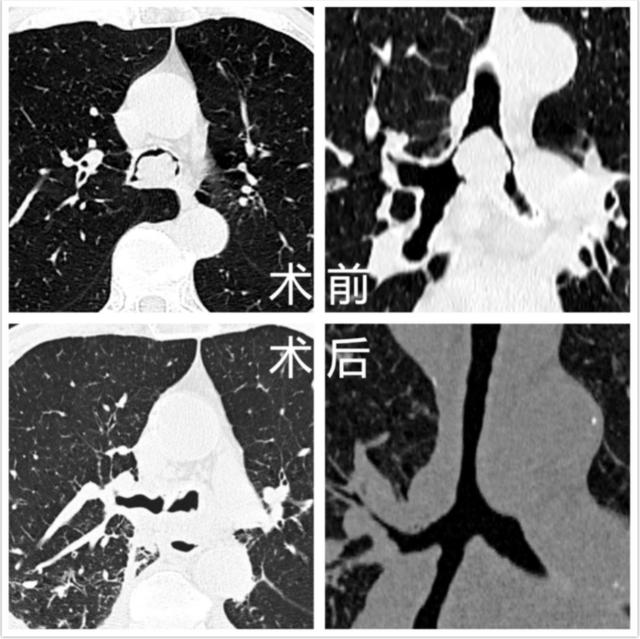 吉林省首例！这次手术历经3小时25分